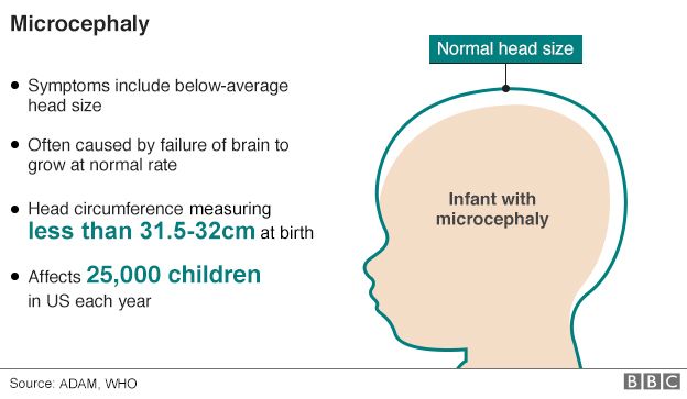 Micrcephaly from Zika